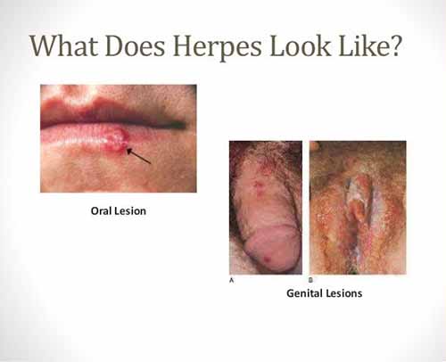 Typical early herpes signs and symptoms